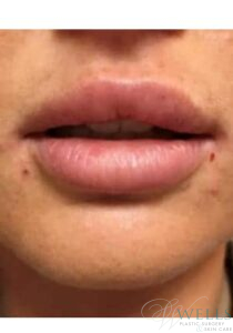 After Image: Fillers