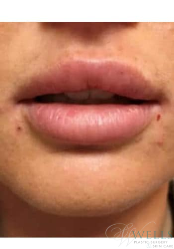 After Image: Fillers - front