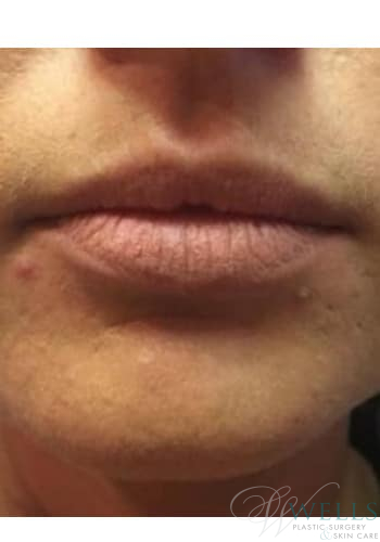 Before Image: Fillers - front