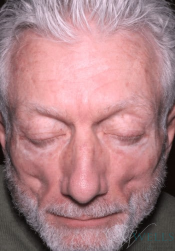 Before Image: Fillers - front