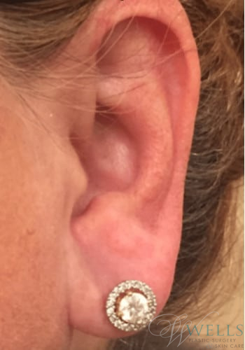 After Image: Fillers - left-side