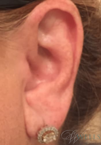 Before Image: Fillers - left-side