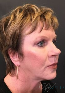After Image: FACELIFT