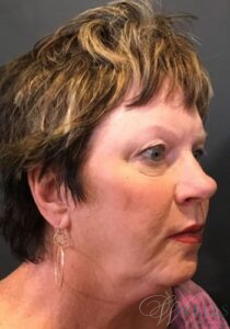 Before Image: FACELIFT