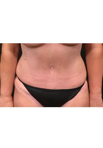 Abdominoplasty