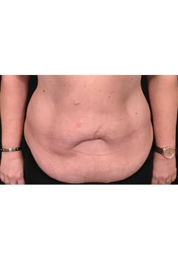 Abdominoplasty