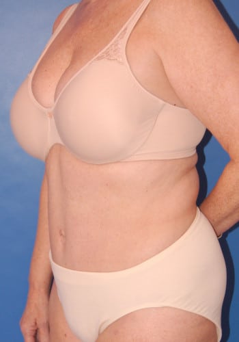 Abdominoplasty