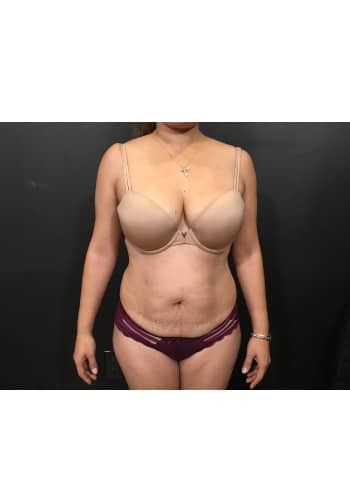 Abdominoplasty