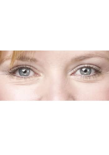 Blepharoplasty