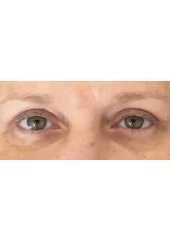 Blepharoplasty