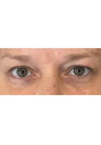 Blepharoplasty