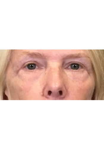 Blepharoplasty