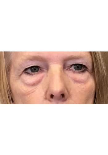 Blepharoplasty